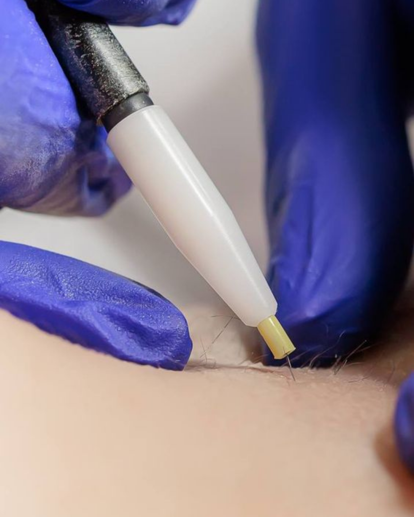 épilation par électrolyse visage femme